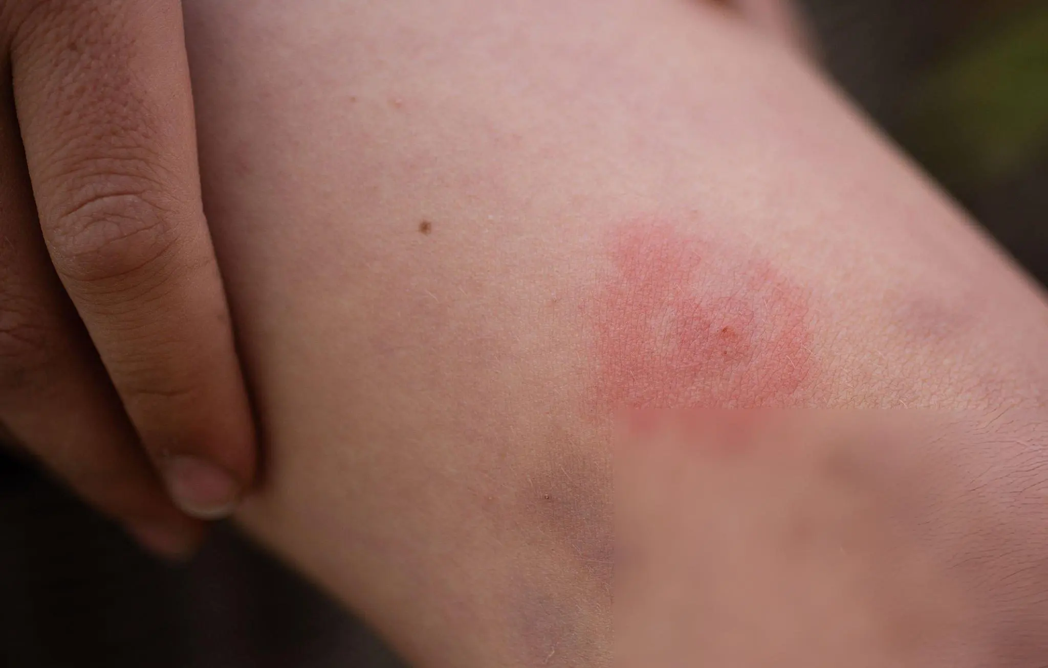Insect Bites
